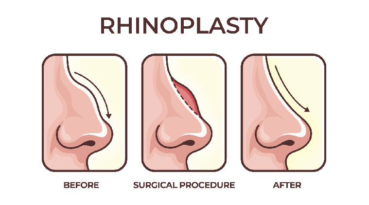 Rhinoplasty Surgery